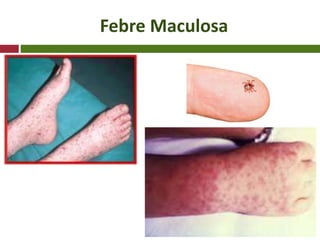 Febre Maculosa
 