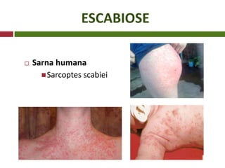 ESCABIOSE
 Sarna humana
Sarcoptes scabiei
 