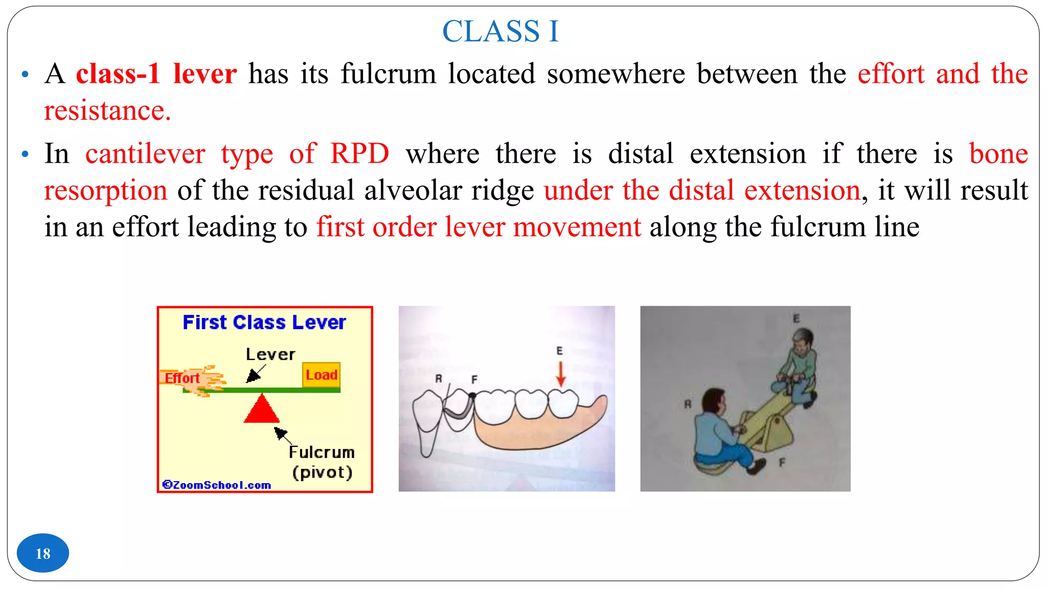 CLASS I
18
• A class-1 lever has its fulcrum located somewhere between the effort and the
resistance.
• In cantilever type of RPD where there is distal extension if there is bone
resorption of the residual alveolar ridge under the distal extension, it will result
in an effort leading to first order lever movement along the fulcrum line
 