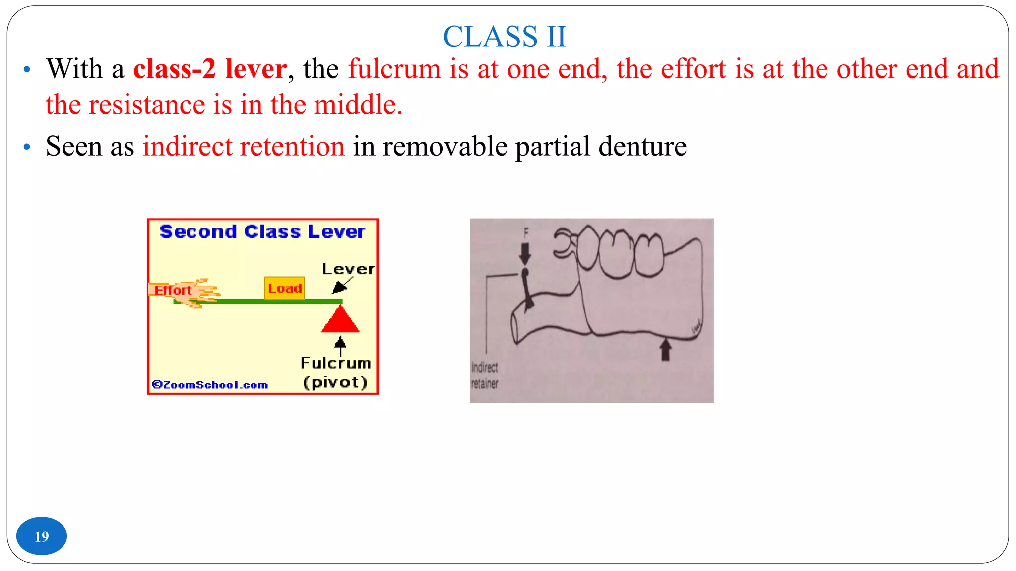 CLASS II
19
• With a class-2 lever, the fulcrum is at one end, the effort is at the other end and
the resistance is in the middle.
• Seen as indirect retention in removable partial denture
 