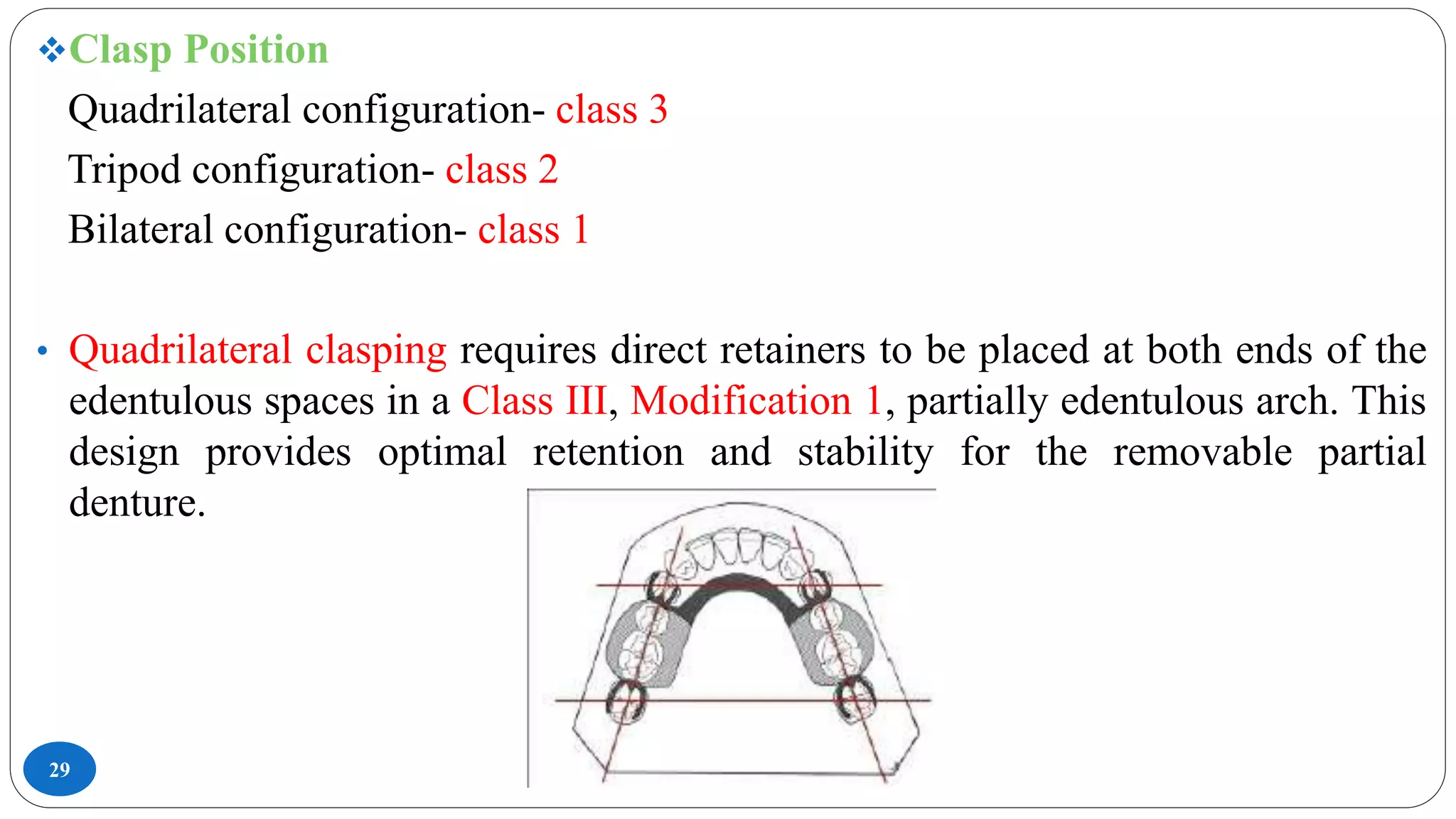 29
Clasp Position
Quadrilateral configuration- class 3
Tripod configuration- class 2
Bilateral configuration- class 1
• Quadrilateral clasping requires direct retainers to be placed at both ends of the
edentulous spaces in a Class III, Modification 1, partially edentulous arch. This
design provides optimal retention and stability for the removable partial
denture.
 