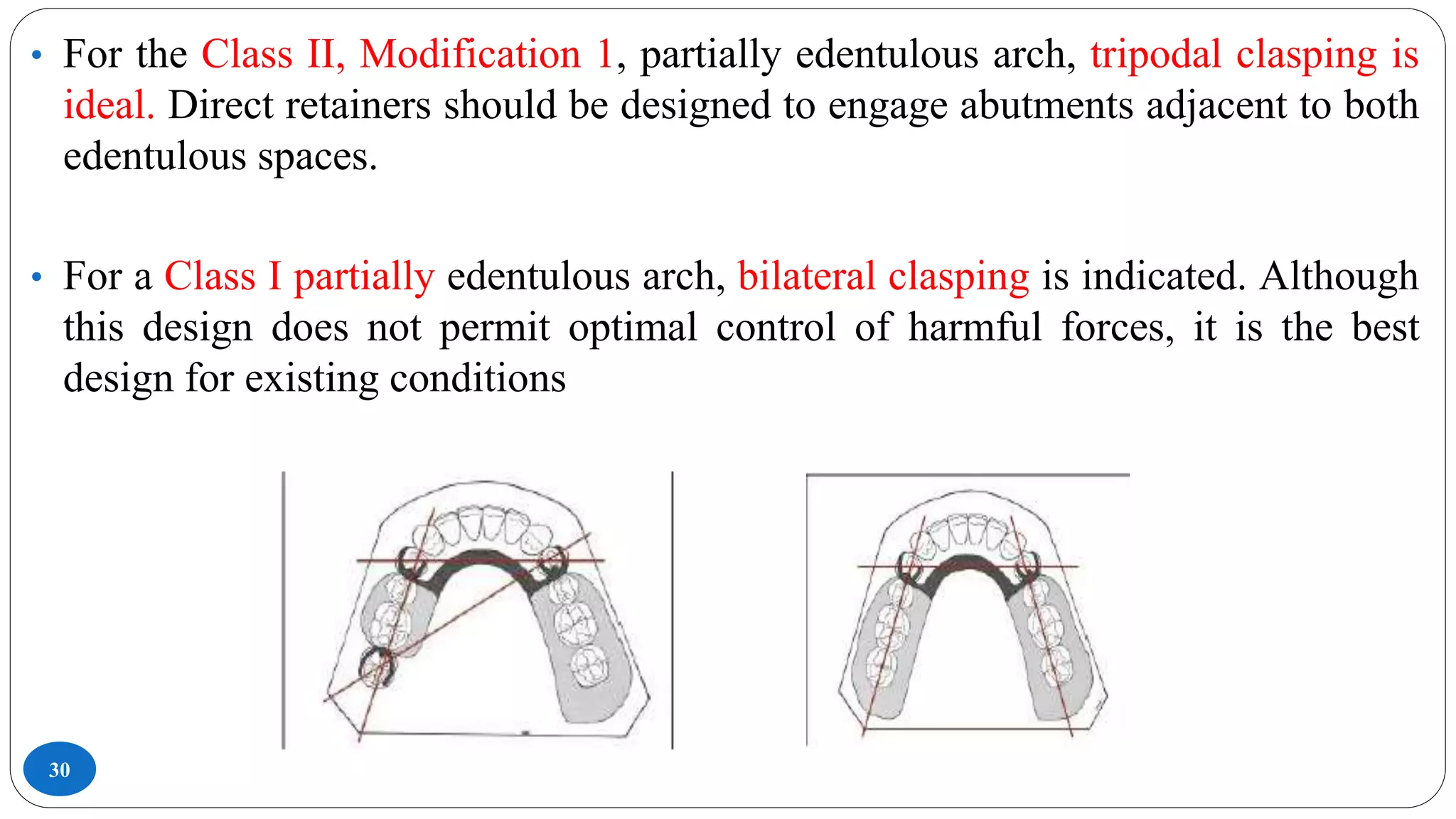 30
• For the Class II, Modification 1, partially edentulous arch, tripodal clasping is
ideal. Direct retainers should be designed to engage abutments adjacent to both
edentulous spaces.
• For a Class I partially edentulous arch, bilateral clasping is indicated. Although
this design does not permit optimal control of harmful forces, it is the best
design for existing conditions
 