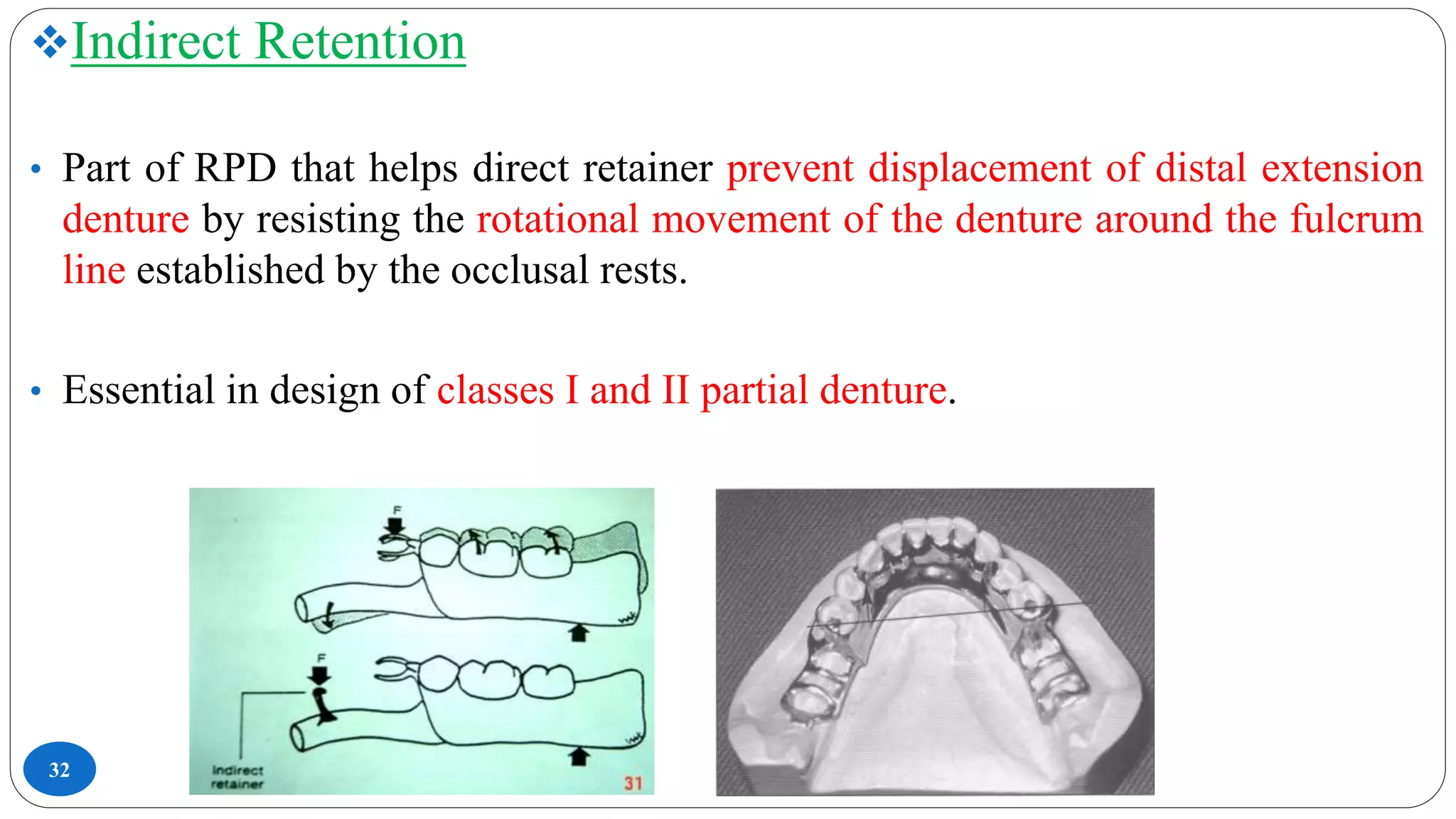 32
Indirect Retention
• Part of RPD that helps direct retainer prevent displacement of distal extension
denture by resisting the rotational movement of the denture around the fulcrum
line established by the occlusal rests.
• Essential in design of classes I and II partial denture.
 