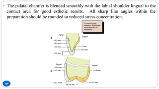 109
• The palatal chamfer is blended smoothly with the labial shoulder lingual to the
contact area for good esthetic results. All sharp line angles within the
preparation should be rounded to reduced stress concentration.
 