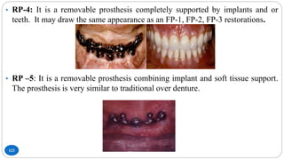 123
• RP-4: It is a removable prosthesis completely supported by implants and or
teeth. It may draw the same appearance as an FP-1, FP-2, FP-3 restorations.
• RP –5: It is a removable prosthesis combining implant and soft tissue support.
The prosthesis is very similar to traditional over denture.
 