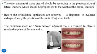 150
• The exact amount of space created should be according to the proposed size of
lateral incisors, which should be proportions to the width of the central incisors.
• Before the orthodontic appliances are removed it is important to evaluate
radiographically the position of the roots of adjacent teeth.
• The minimum space of 6.5mm between adjacent roots is required to place a
standard implant of 3mmm width.
 