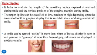 Upper lip line
17
• It helps to evaluate the length of the maxillary incisor exposed at rest and
during smile and the vertical position of the gingival margins during smile.
• The upper lip line can be classified as low, medium or high depending upon the
amount of tooth or gingival display that is available at rest of during a moderate
smile.
• It helps to evaluate the length of the maxillary incisor exposed at rest and
during smile and the vertical position of the gingival margins during smile.
• The upper lip line can be classified as low, medium or high depending upon the
amount of tooth or gingival display that is available at rest of during a moderate
smile.
• A smile can be termed “toothy” if more than 6mm of incisal display is seen at
rest position or “gummy” if more than 3mm of gingival tissues are displayed in
moderate smile.
 