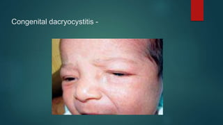 Congenital dacryocystitis -
 