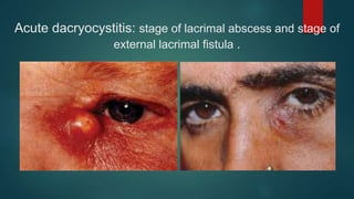 Acute dacryocystitis: stage of lacrimal abscess and stage of
external lacrimal fistula .
 