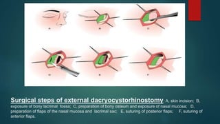 Surgical steps of external dacryocystorhinostomy: A, skin incision; B,
exposure of bony lacrimal fossa; C, preparation of bony osteum and exposure of nasal mucosa; D,
preparation of flaps of the nasal mucosa and lacrimal sac; E, suturing of posterior flaps; F, suturing of
anterior flaps.
 