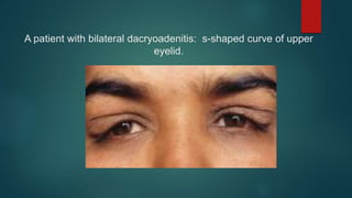 A patient with bilateral dacryoadenitis: s-shaped curve of upper
eyelid.
 