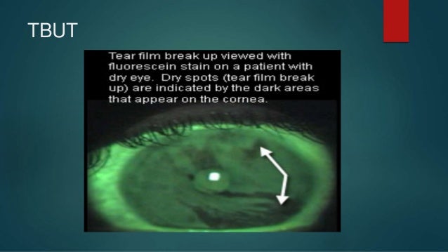 Lacrimal apparatus - diseases.