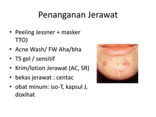 Penanganan Jerawat
• Peeling Jessner + masker
TTO)
• Acne Wash/ FW Aha/bha
• TS gel / sensitif
• Krim/lotion Jerawat (AC, SR)
• bekas jerawat : centac
• obat minum: iso-T, kapsul J,
doxihat
 