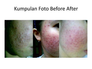 Kumpulan Foto Before After
 