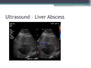 seminar liver abscess complication management | PPTX