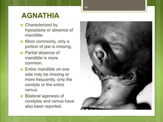 AGNATHIA
 Characterized by
hypoplasia or absence of
mandible.
 More commonly, only a
portion of jaw is missing.
 Partial absence of
mandible is more
common.
 Entire mandible on one
side may be missing or
more frequently, only the
condyle or the entire
ramus.
 Bilateral agenesis of
condyles and ramus have
also been reported.
40
 