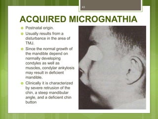 ACQUIRED MICROGNATHIA
 Postnatal origin.
 Usually results from a
disturbance in the area of
TMJ.
 Since the normal growth of
the mandible depend on
normally developing
condyles as well as
muscles, condylar ankylosis
may result in deficient
mandible.
 Clinically it is characterized
by severe retrusion of the
chin, a steep mandibular
angle, and a deficient chin
button
43
 