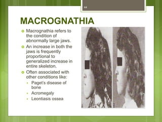 MACROGNATHIA
 Macrognathia refers to
the condition of
abnormally large jaws.
 An increase in both the
jaws is frequently
proportional to
generalized increase in
entire skeleton.
 Often associated with
other conditions like:
 Paget’s disease of
bone
 Acromegaly
 Leontiasis ossea
44
 