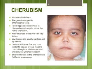 CHERUBISM
 Autosomal dominant
 The gene is mapped to
chromosome 4p16.
 Facial appearance is similar to
plump-cheeked angels, hence the
name cherubism.
 First described in the year 1953 by
Jones.
 Jaw lesions are usually painless and
symmetric.
 Lesions which are firm and non-
tender to palpate involve molar to
coronoid regions, often associated
with cervical lymphadenopathy.
 This contributes to the characteristic
full-faced appearance.
50
 