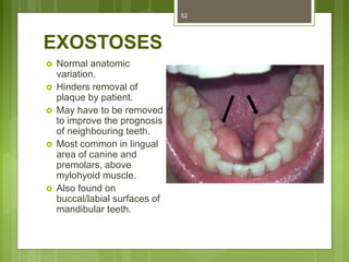EXOSTOSES
 Normal anatomic
variation.
 Hinders removal of
plaque by patient.
 May have to be removed
to improve the prognosis
of neighbouring teeth.
 Most common in lingual
area of canine and
premolars, above
mylohyoid muscle.
 Also found on
buccal/labial surfaces of
mandibular teeth.
52
 