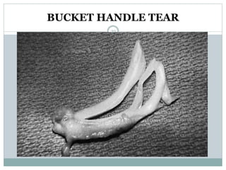 BUCKET HANDLE TEAR
21
 
