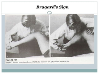 Bragard’s Sign
38
 