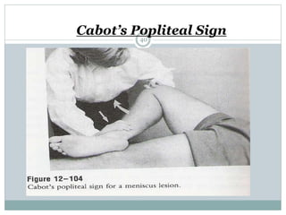 Cabot’s Popliteal Sign
40
 