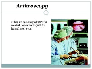Arthroscopy
• It has an accuracy of 98% for
medial meniscus & 90% for
lateral meniscus.
43
 