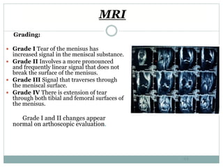 MRI
Grading:
 Grade I Tear of the menisus has
increased signal in the meniscal substance.
 Grade II Involves a more pronounced
and frequently linear signal that does not
break the surface of the menisus.
 Grade III Signal that traverses through
the meniscal surface.
 Grade IV There is extension of tear
through both tibial and femoral surfaces of
the menisus.
Grade I and II changes appear
normal on arthoscopic evaluation.
44
 