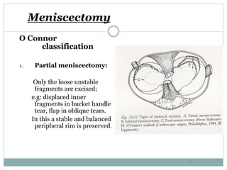 Meniscectomy
O Connor
classification
1. Partial meniscectomy:
Only the loose unstable
fragments are excised;
e.g: displaced inner
fragments in bucket handle
tear, flap in oblique tears.
In this a stable and balanced
peripheral rim is preserved.
53
 