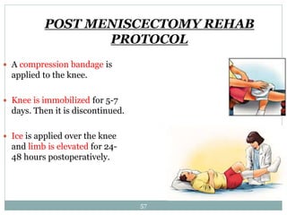 POST MENISCECTOMY REHAB
PROTOCOL
 A compression bandage is
applied to the knee.
 Knee is immobilized for 5-7
days. Then it is discontinued.
 Ice is applied over the knee
and limb is elevated for 24-
48 hours postoperatively.
57
 