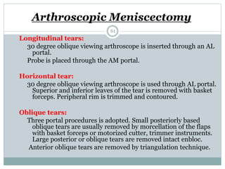 Arthroscopic Meniscectomy
Longitudinal tears:
30 degree oblique viewing arthroscope is inserted through an AL
portal.
Probe is placed through the AM portal.
Horizontal tear:
30 degree oblique viewing arthroscope is used through AL portal.
Superior and inferior leaves of the tear is removed with basket
forceps. Peripheral rim is trimmed and contoured.
Oblique tears:
Three portal procedures is adopted. Small posteriorly based
oblique tears are usually removed by morcellation of the flaps
with basket forceps or motorized cutter, trimmer instruments.
Large posterior or oblique tears are removed intact enbloc.
Anterior oblique tears are removed by triangulation technique.
61
 