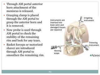  Through AM portal anterior
horn attachment of the
meniscus is released.
 Grasping clamp is placed
through the AM portal to
grasp the anterior horn and
it is removed.
 Now probe is used through
AM portal to check the
stability of the remaining
rim and look for any tears.
 Basket forceps or motorized
shaver are introduced
through AM portal to
smoothen the remaining rim.
63
 