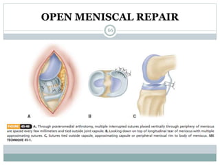 OPEN MENISCAL REPAIR
66
 