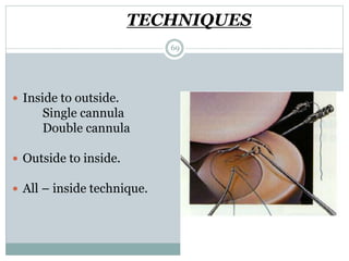 TECHNIQUES
 Inside to outside.
Single cannula
Double cannula
 Outside to inside.
 All – inside technique.
69
 