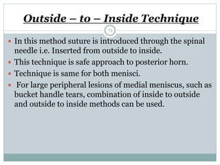 Outside – to – Inside Technique
 In this method suture is introduced through the spinal
needle i.e. Inserted from outside to inside.
 This technique is safe approach to posterior horn.
 Technique is same for both menisci.
 For large peripheral lesions of medial meniscus, such as
bucket handle tears, combination of inside to outside
and outside to inside methods can be used.
71
 
