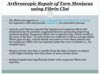 Arthroscopic Repair of Torn Meniscus
using Fibrin Clot
 The fibrin clot appears to act as a chemotoctic and mitogenic stimulus
for reparative cells and provide scaffolding for reparative process.
 Arnocky and Warren reported the injection of exogenous fibrin clot
obtained form the patients coagulated blood as promoting improving
meniscal healing. Exogenous fibrin clot is injected with a blunt needle in
the stem of the tear. 1 to 2ml of clot was sufficient to fill an average defect.
When gaps are big, a facial sheath was used to cover these defects and
the exogenous fibrin clot was injected under the cover of sheath i.e., for
complex tears.
 Repairs of tears less than 2 months from the time of injury to surgery
result higher healing rates than those of more chronic tears.
 Isolated repairs heal significantly better with exogenous fibrin clot
injection.
85
 