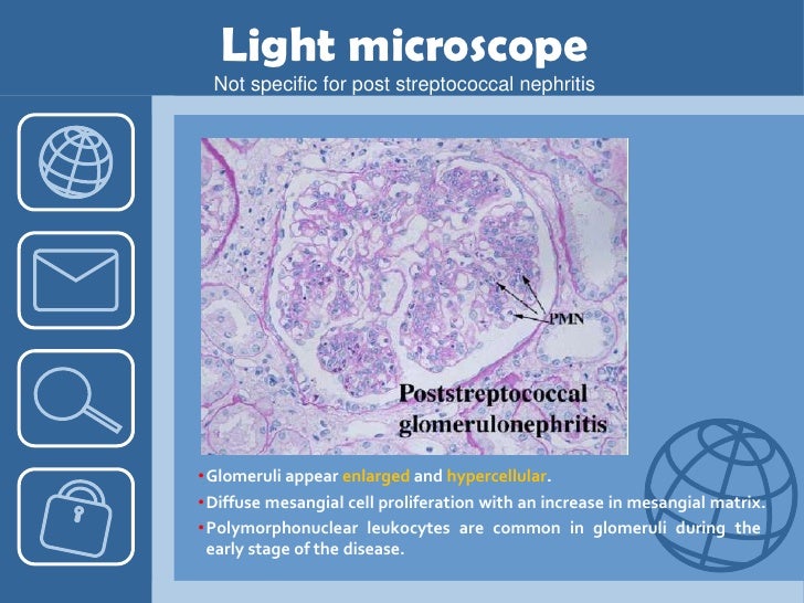 Acute Poststreptococcal Glomerulonephritis