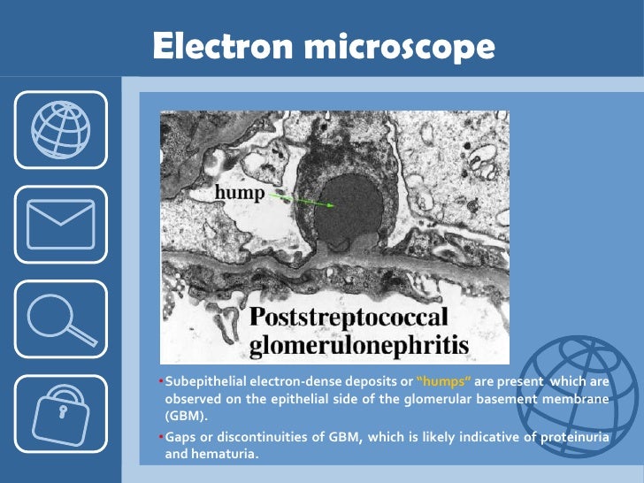 Acute Poststreptococcal Glomerulonephritis