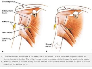 Seminar on applied anatomy and surgical approaches to shoulder | PPTX