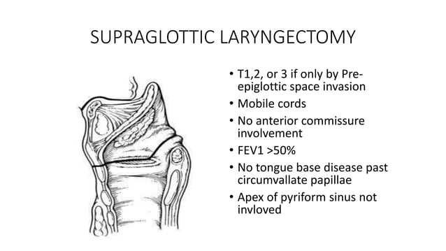 Seminar on cancer of larynx PPTX