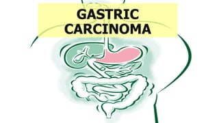 GASTRIC
CARCINOMA
 