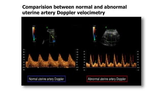 Comparision between normal and abnormal
uterine artery Doppler velocimetry
 