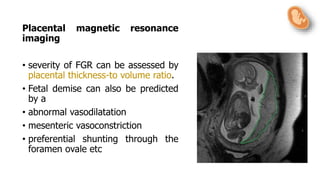 Placental magnetic resonance
imaging
• severity of FGR can be assessed by
placental thickness-to volume ratio.
• Fetal demise can also be predicted
by a
• abnormal vasodilatation
• mesenteric vasoconstriction
• preferential shunting through the
foramen ovale etc
 