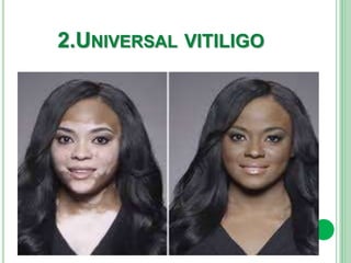 2.UNIVERSAL VITILIGO
 