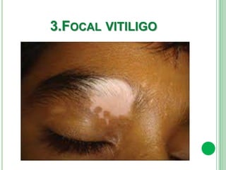 3.FOCAL VITILIGO
 