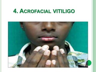 4. ACROFACIAL VITILIGO
 