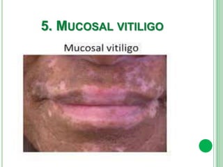 5. MUCOSAL VITILIGO
 