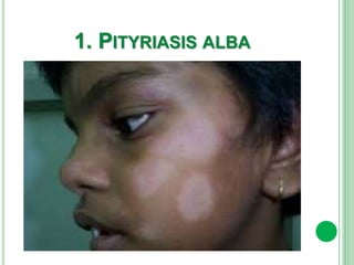1. PITYRIASIS ALBA
 