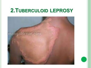 2.TUBERCULOID LEPROSY
 